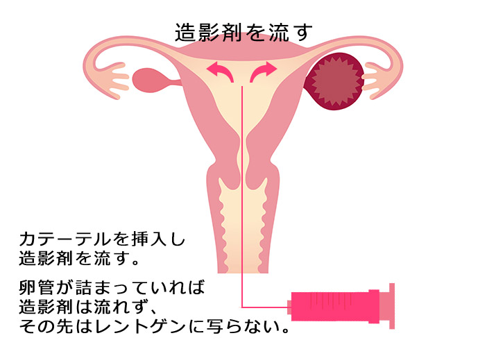 子宮卵管造影検査方法